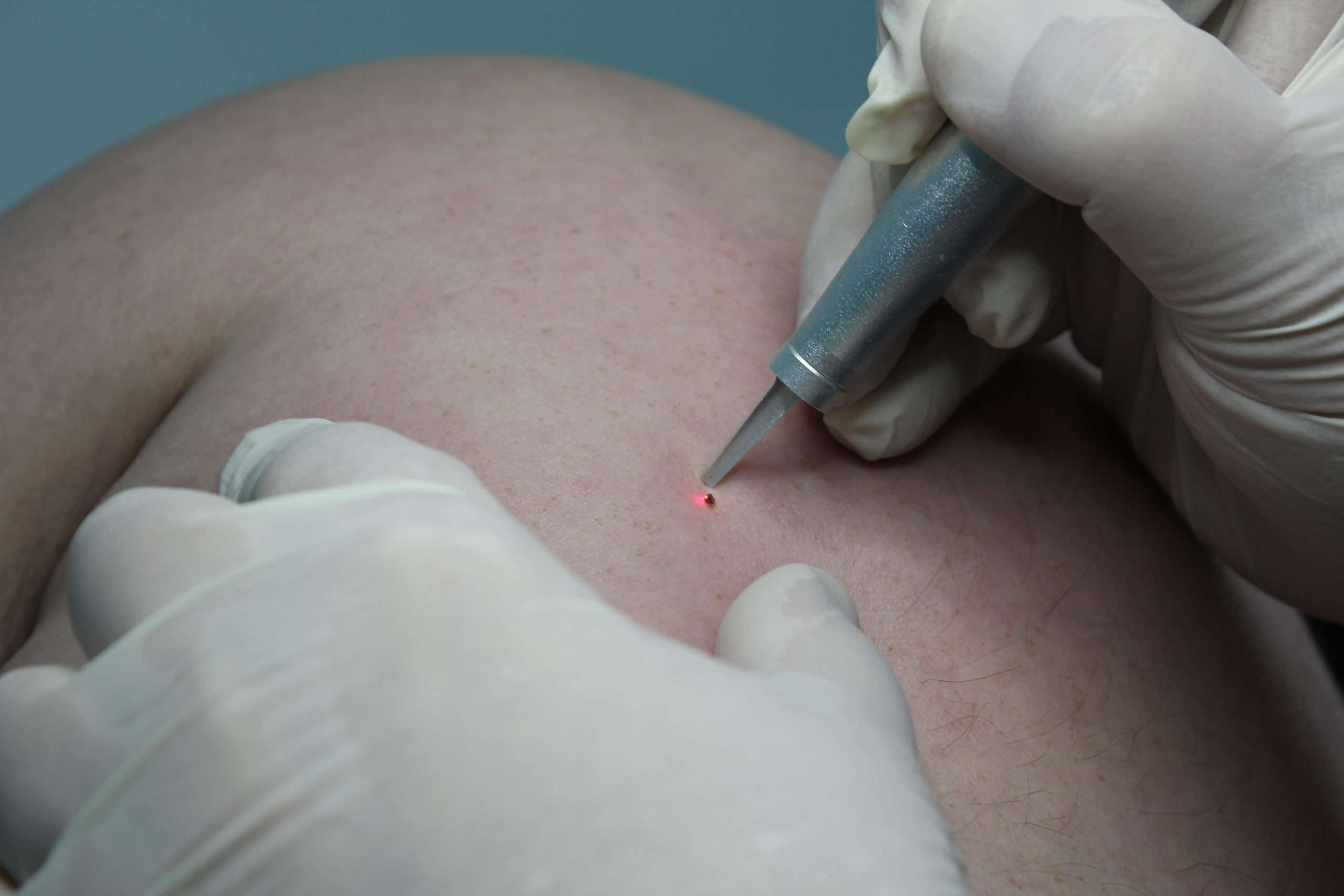 николаев медикал авиценна медицинский центр лазер co2 цо2