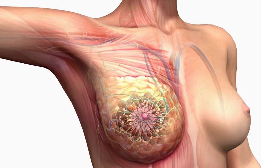 Почему возникает миозит грудных мышц?